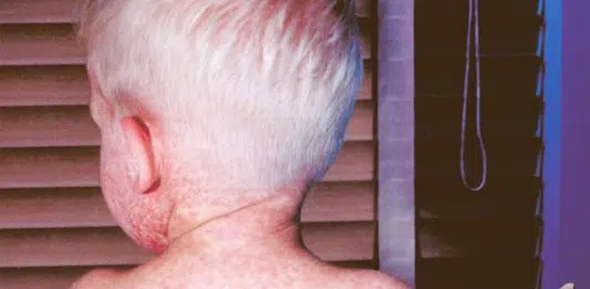 7 choses que les parents doivent savoir sur la rougeole