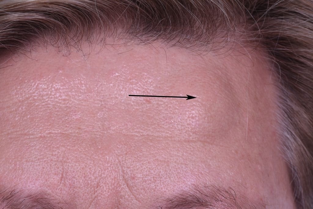 Skin Cancer Lump On Forehead vrogue.co